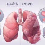 COPD நோய் குறித்து வைத்தியர்களின் விசேட அறிவுறுத்தல்