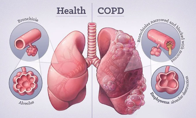 COPD நோய் குறித்து வைத்தியர்களின் விசேட அறிவுறுத்தல்